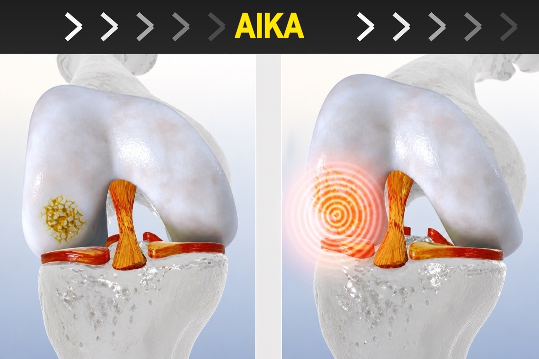 Knee cartilage damage and support over time
